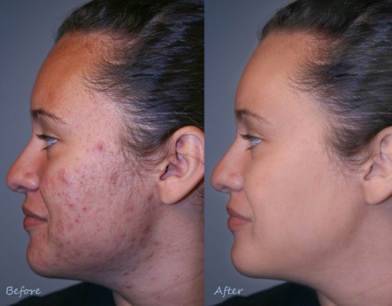 Laser Acne Scar Treatment