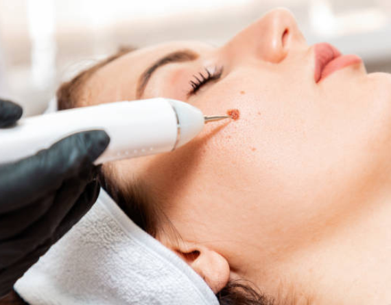 Laser Mole & Wart Removal